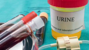 lupus symptoms and diagnosis